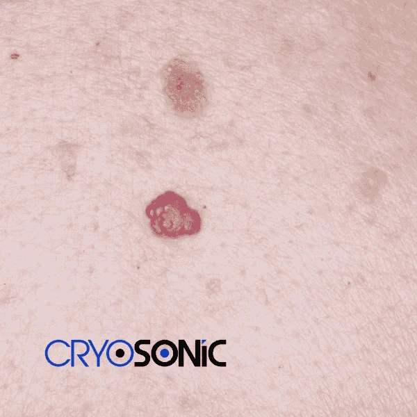 Looking for pain free cherry angioma removal treatment Crawley? Call our team today! Crawley