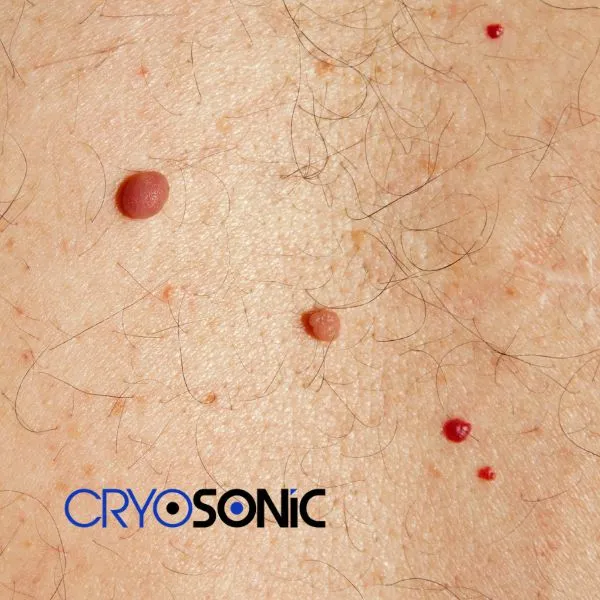 get cherry angioma removal treatment today! Crawley