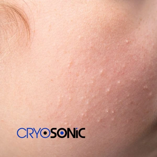 Are you looking for milia removal treatment? Contact our team today Crawley