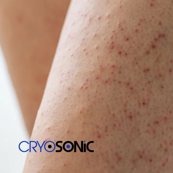 Looking for Seborrhoeic Keratosis removal Crawley treatment? Call our consultants today in Crawley