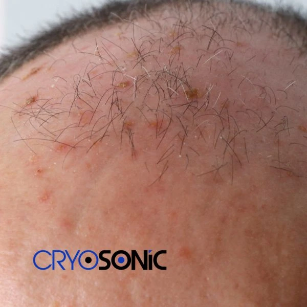 Access Seborrhoeic Keratosis removal from the comfort of your own home! Call us today in Crawley
