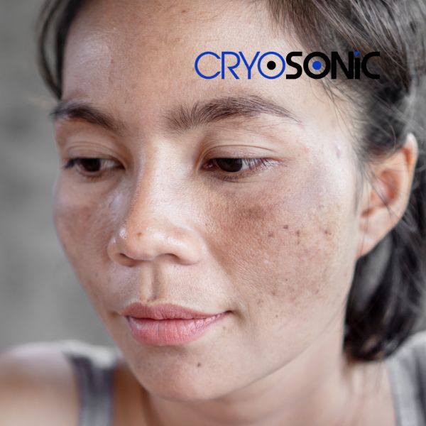 Ready to start age spots removal? Contact our team today in Crawley