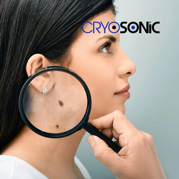 Do you want to learn more about benign moles removal treatment? Call our team today Crawley