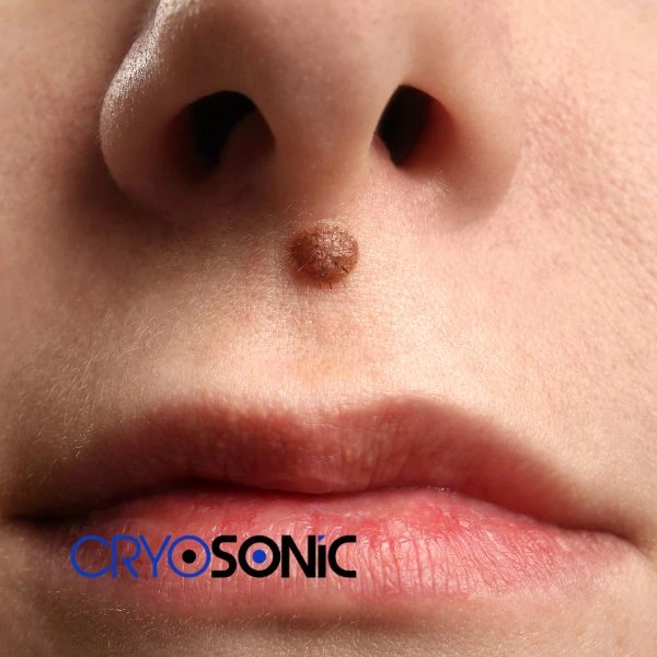 Start your benign moles removal treatment today Crawley