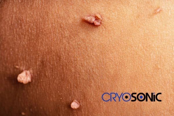 What Can You Expect During and After Your Cryosonic Treatment Crawley