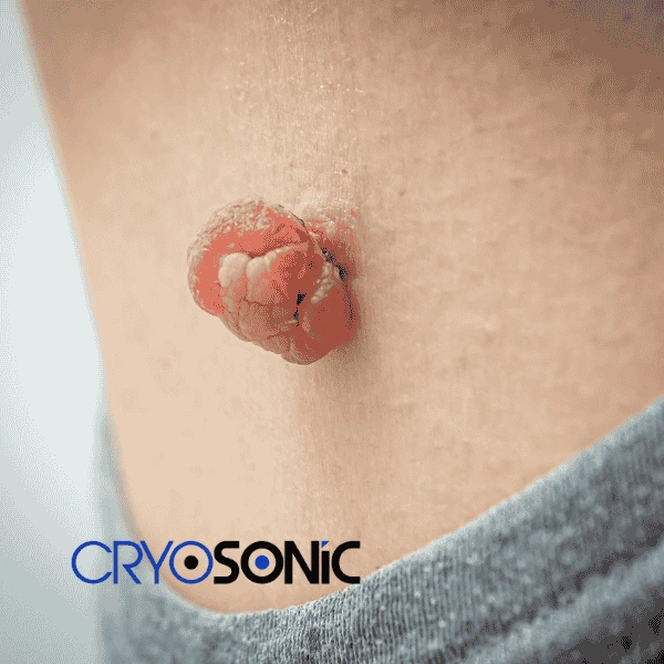 Book your skin tags removal Crawley from comfort of your own home! Crawley