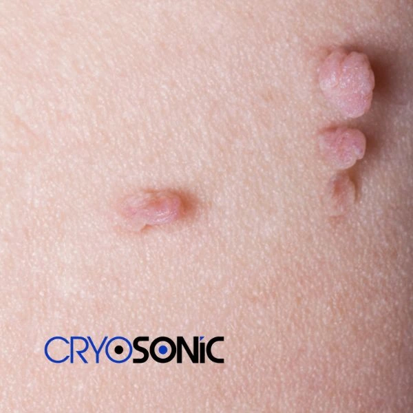 Are you looking for fast effect skin tag removal Crawley? Book in NOW! Crawley