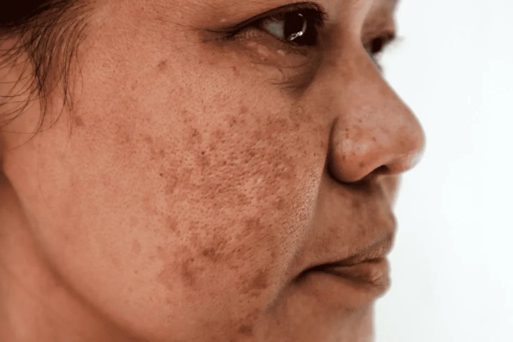 Cryosonic Repair Sun-Damaged Skin Crawley Crawley