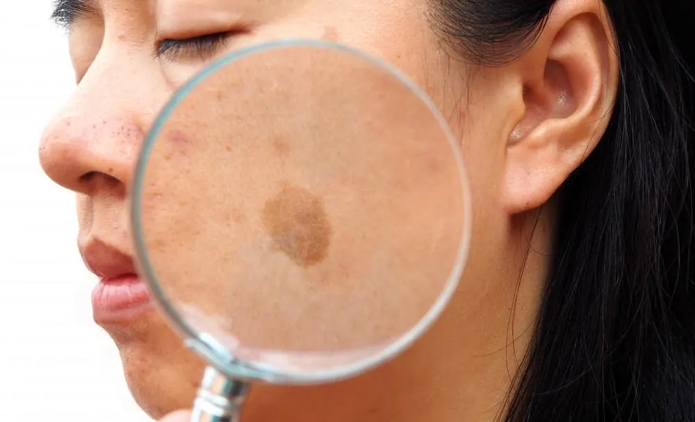 How Seborrheic Keratosis Crawley appears on the skin Crawley