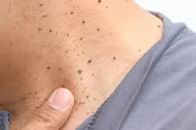 Seborrheic Keratosis: Understanding Skin Changes and CryoPen Treatment Options Crawley