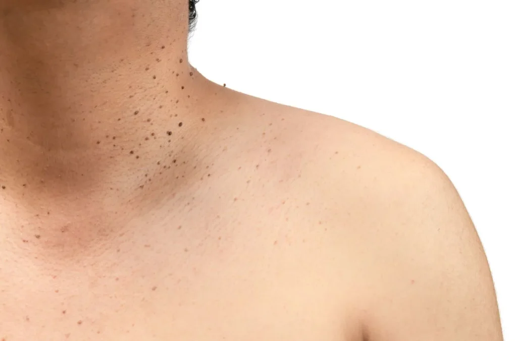 How to Maintain Healthy Skin After Treatment Crawley? Crawley