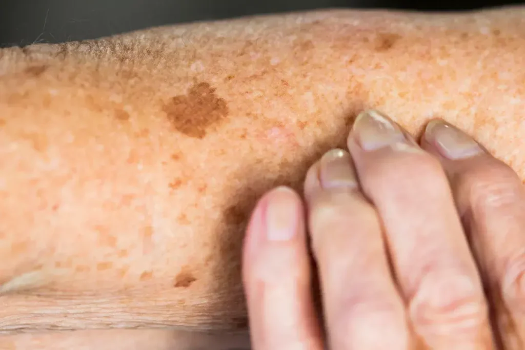 Why Is Early Treatment of Sun Damage Important Crawley? Crawley