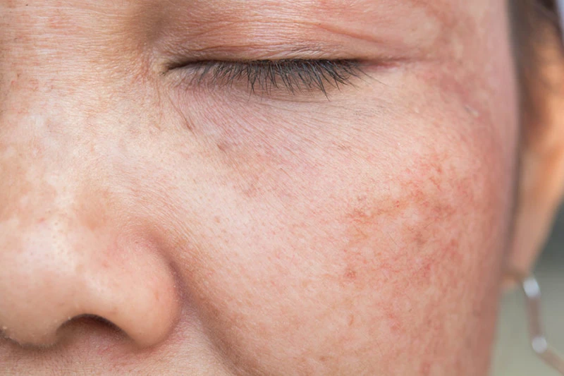 UV rays affecting skin cells, showing sun damage and the need for Cryosonic repair treatments Crawley. Crawley