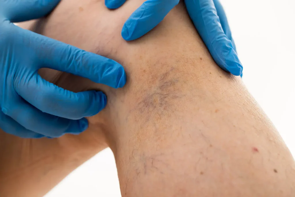 Spider Veins vs. Spider Angiomas: Understanding the Differences in CryoPen Crawley