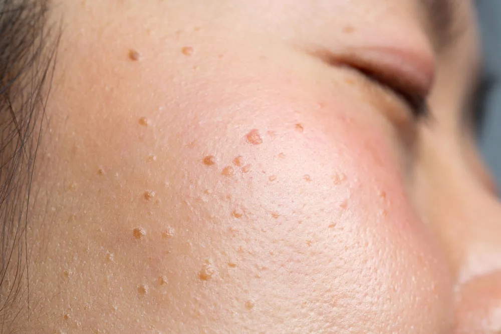 Why Choose CryoPen for Seborrheic Keratosis Crawley Crawley