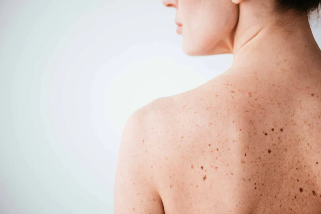 Sun Damage : Understanding UV Effects and Skin Repair Options Crawley